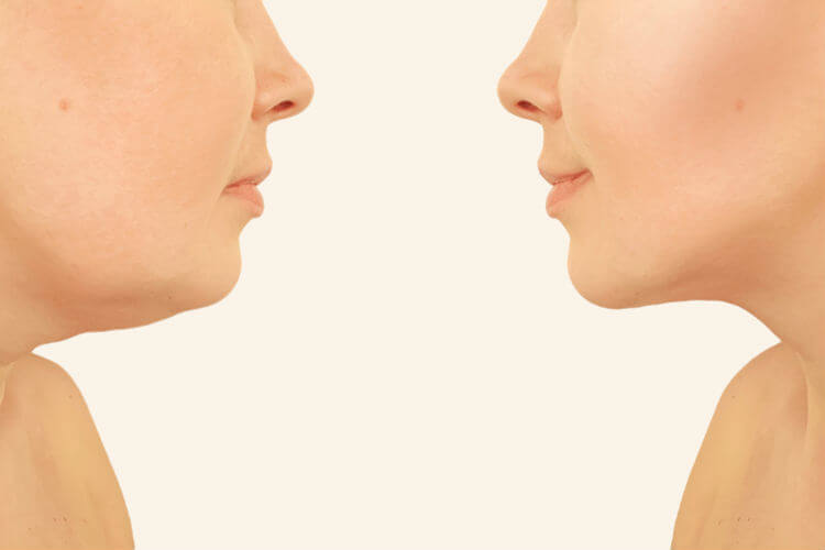 Emagrecimento facial