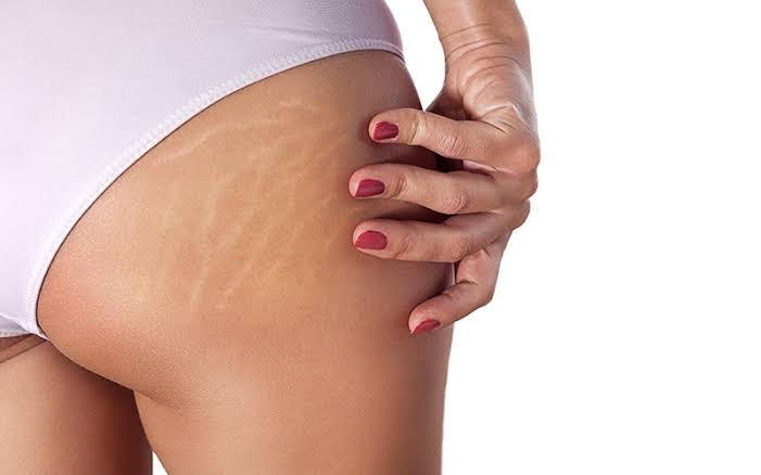 Tratamento para estrias vermelhas e brancas
