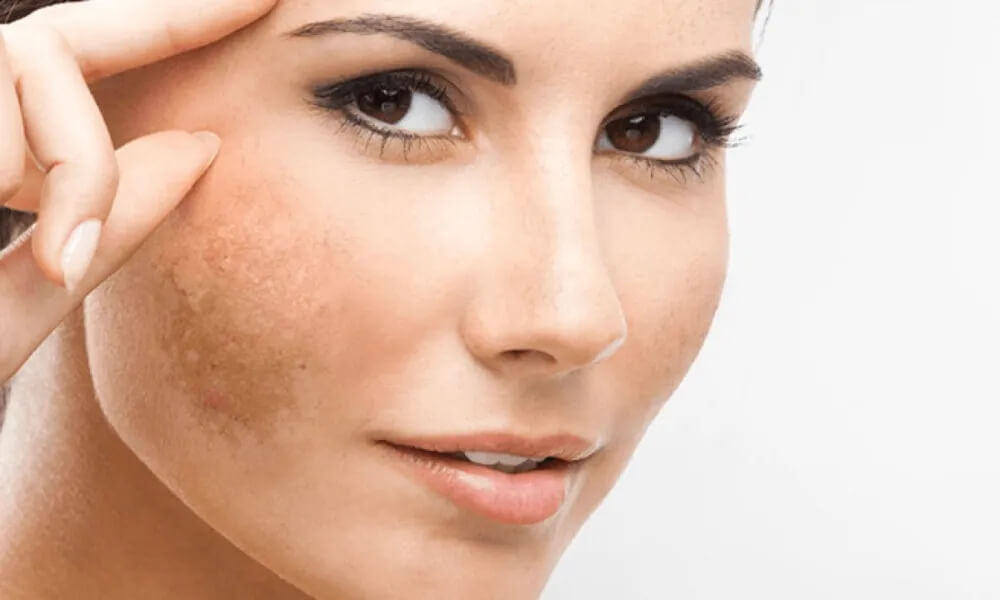 Protocolo DD Melasma